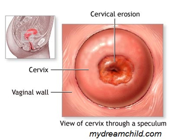 Cervical Erosion